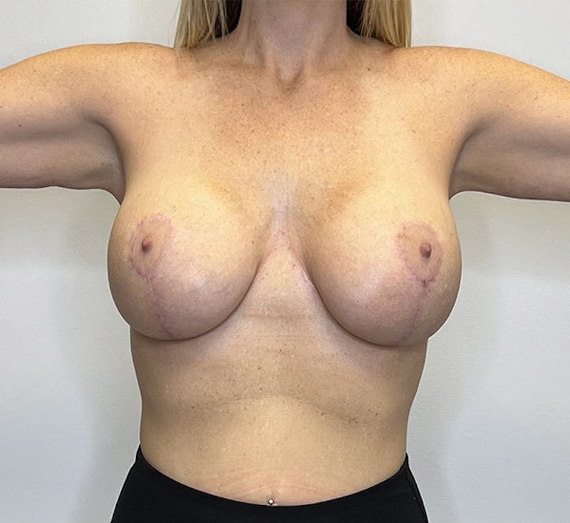 Breast Augmentation with Mastopexy Before & After Gallery - Patient 93879184 - Image 2
