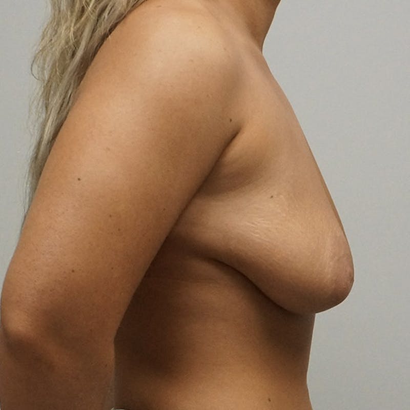 Breast Augmentation with Mastopexy Before & After Gallery - Patient 93879213 - Image 3