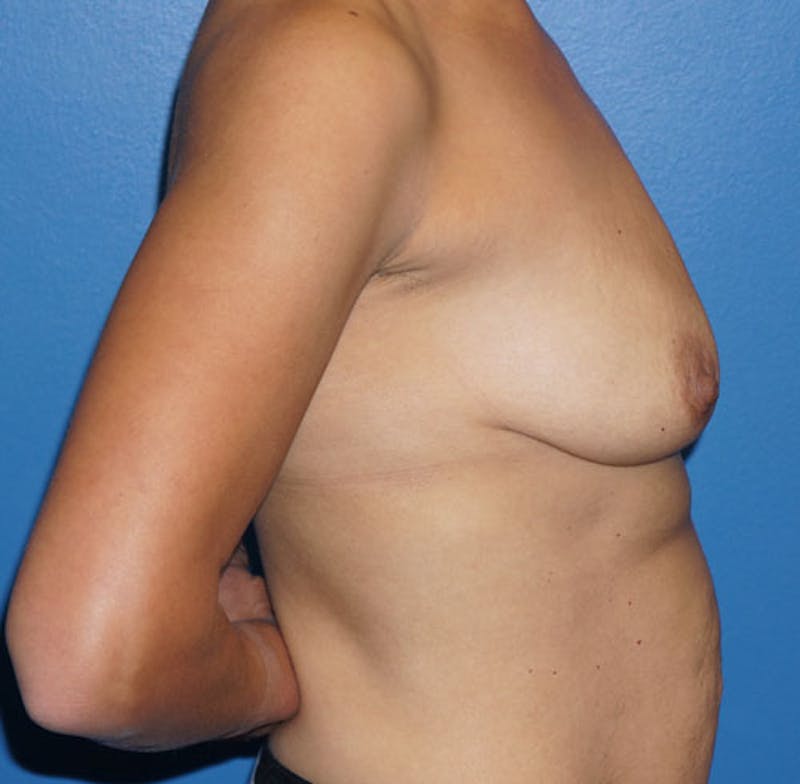 Breast Lift Before & After Gallery - Patient 93879240 - Image 3