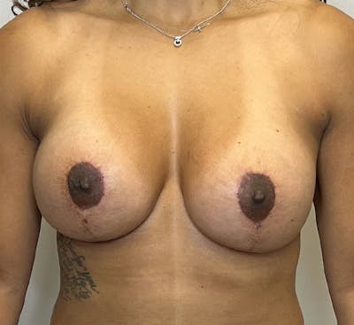 Breast Revision Surgery Before & After Gallery - Patient 93887957 - Image 2