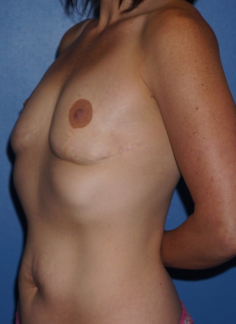 Breast Revision Surgery Before & After Gallery - Patient 93891274 - Image 3