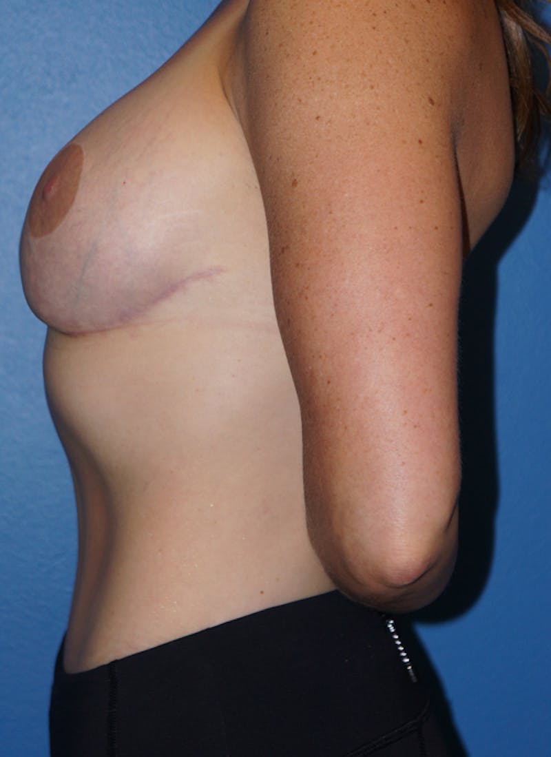 Breast Revision Surgery Before & After Gallery - Patient 93891274 - Image 6
