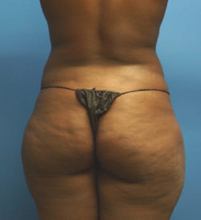 Brazilian Butt Lift Before & After Gallery - Patient 93894286 - Image 1