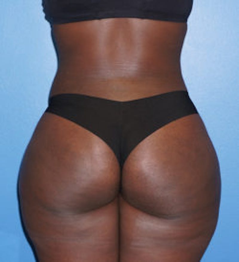 Brazilian Butt Lift Before & After Gallery - Patient 93894286 - Image 2