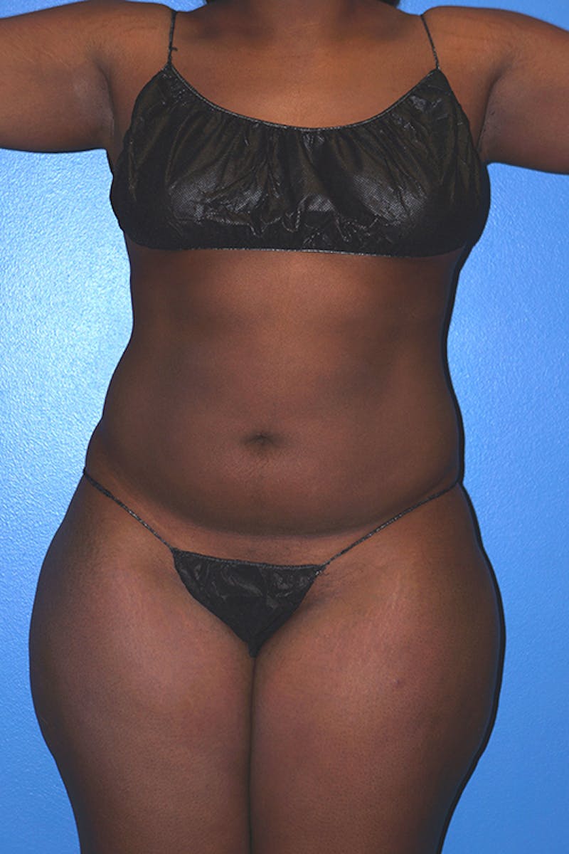 Brazilian Butt Lift Before & After Gallery - Patient 93894286 - Image 7