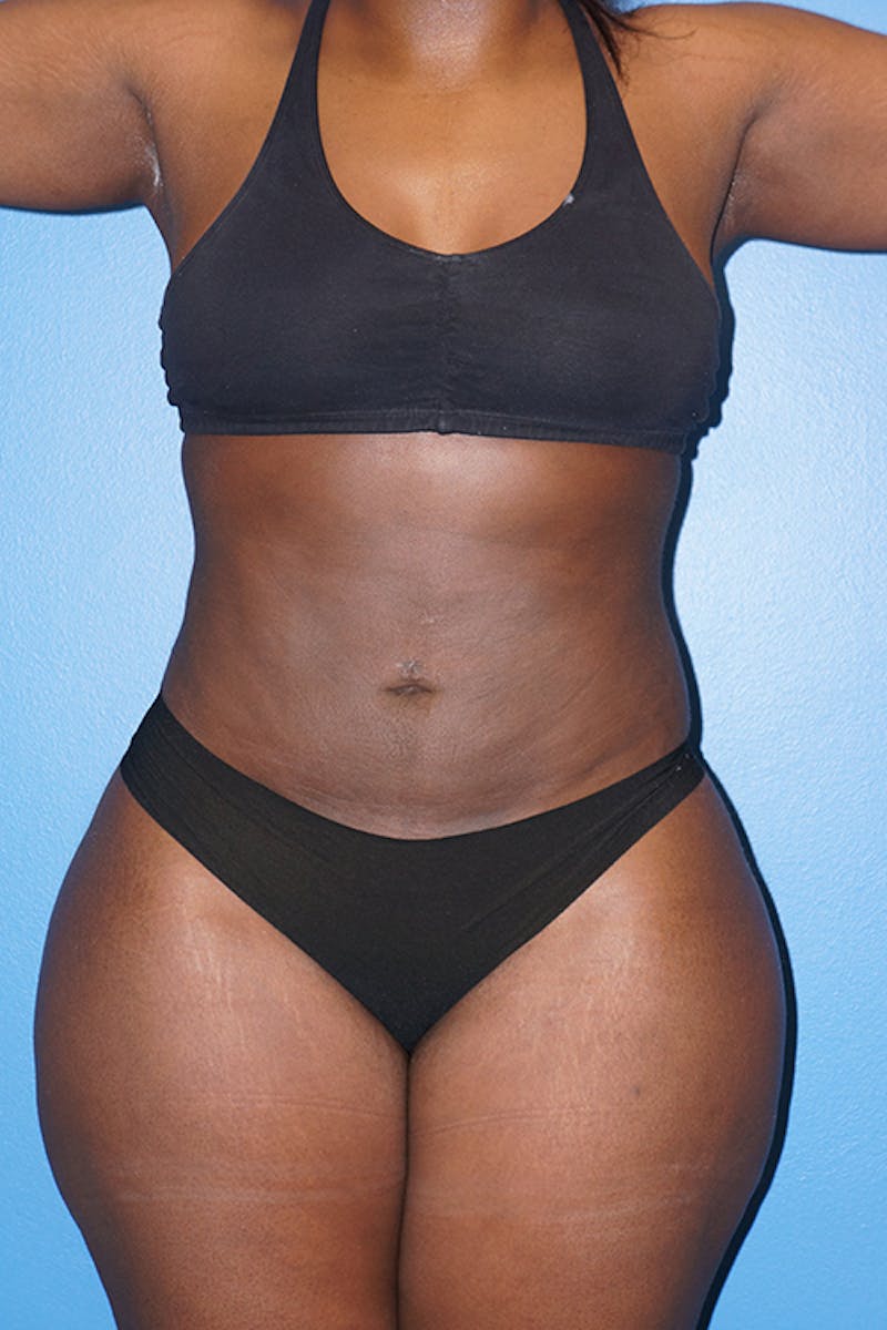Brazilian Butt Lift Before & After Gallery - Patient 93894286 - Image 8