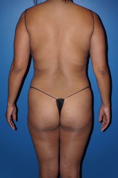 Brazilian Butt Lift Before & After Gallery - Patient 248321 - Image 1