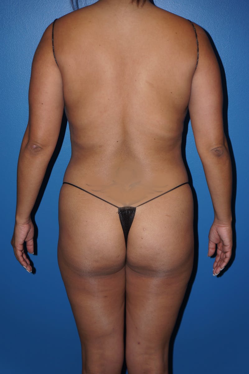 Brazilian Butt Lift Before & After Gallery - Patient 93894360 - Image 1