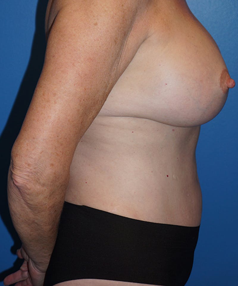 Mommy Makeover Before & After Gallery - Patient 93894345 - Image 6