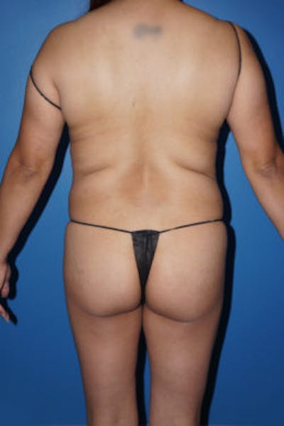 Brazilian Butt Lift Before & After Gallery - Patient 93894381 - Image 1