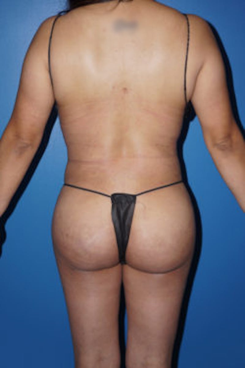 Brazilian Butt Lift Before & After Gallery - Patient 93894381 - Image 2
