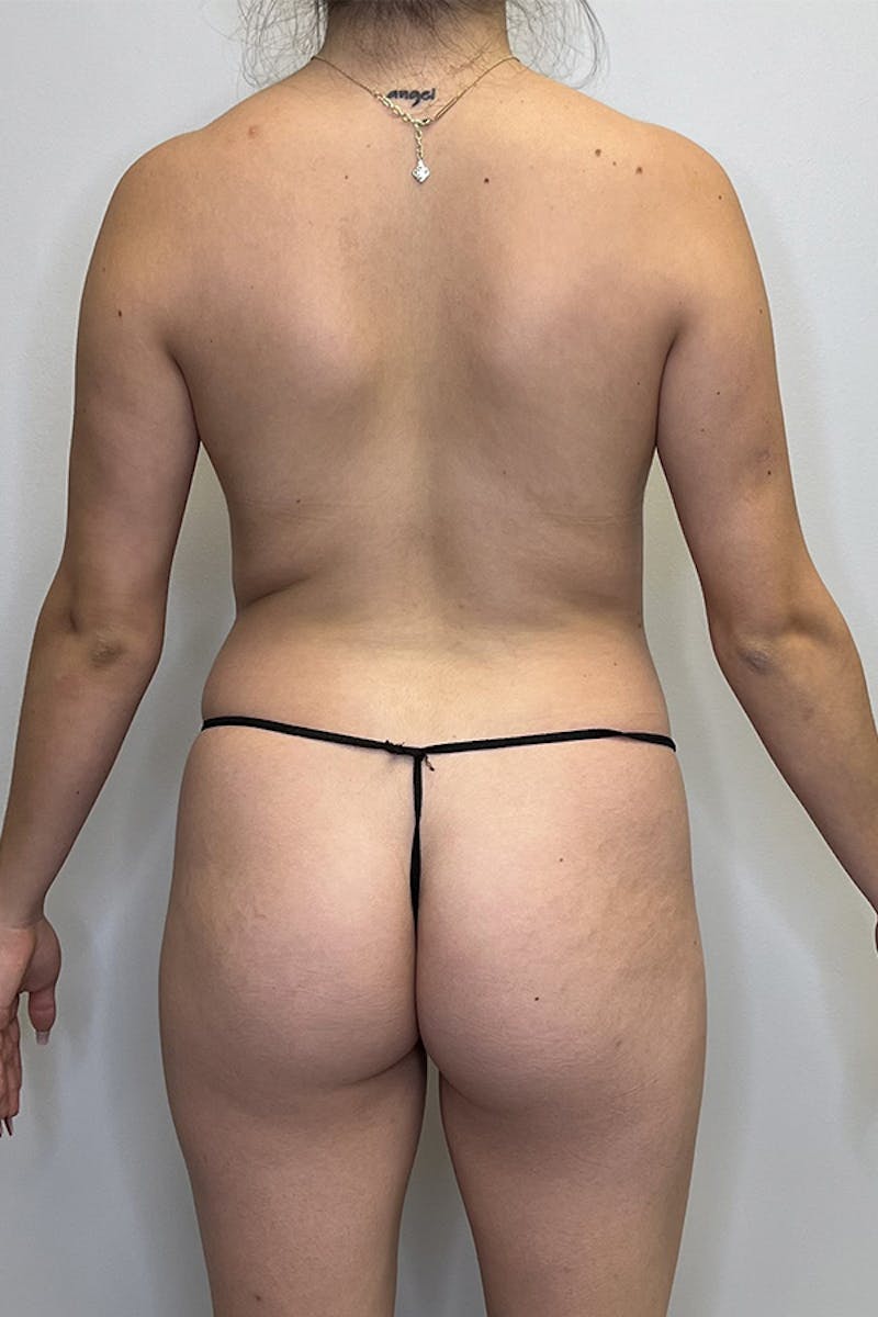 HD Liposuction 360  Before & After Gallery - Patient 93894365 - Image 7