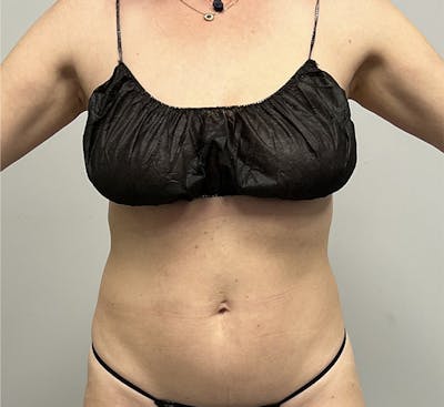 High-definition Liposuction Before & After Gallery - Patient 93894386 - Image 1