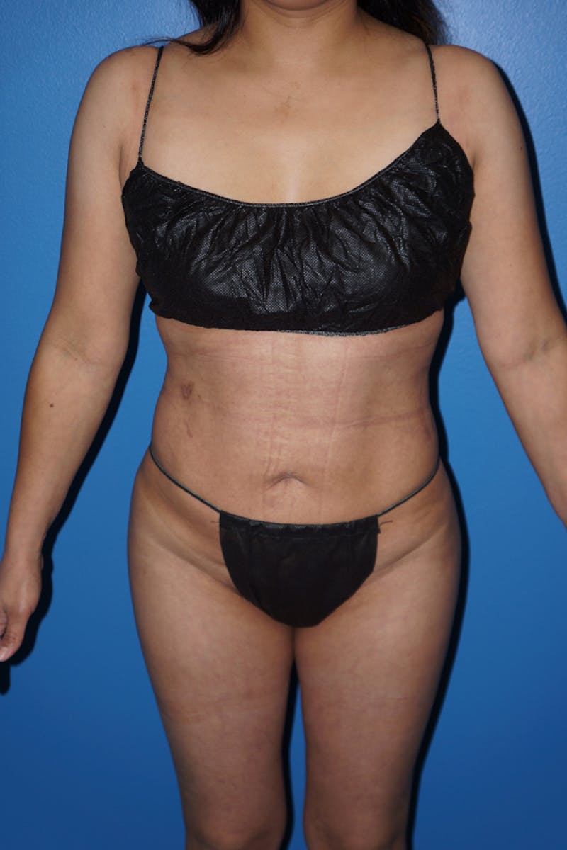 Brazilian Butt Lift Before & After Gallery - Patient 93894381 - Image 6
