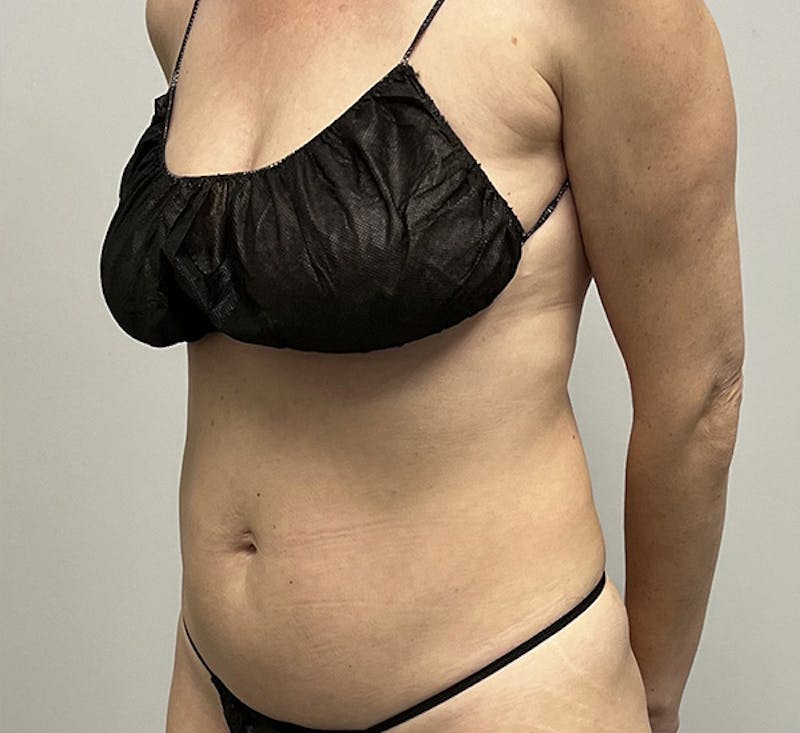 High-definition Liposuction Before & After Gallery - Patient 93894386 - Image 3