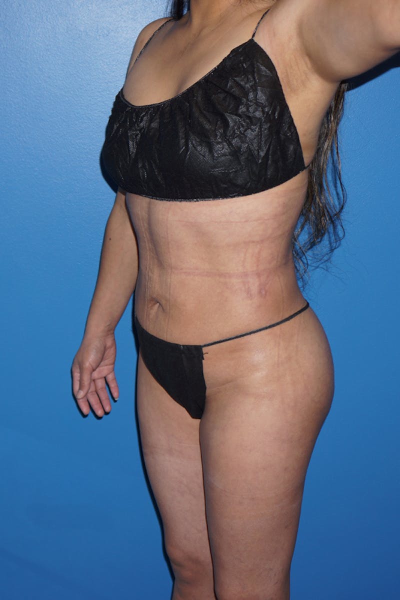 Brazilian Butt Lift Before & After Gallery - Patient 93894381 - Image 8