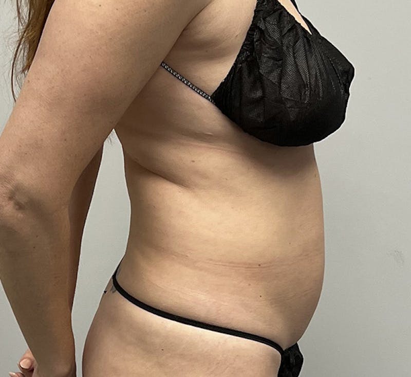 HD Liposuction 360  Before & After Gallery - Patient 93894386 - Image 5