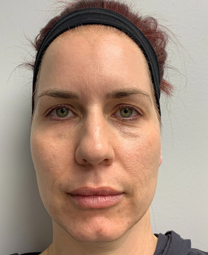 Halo Laser Before & After Gallery - Patient 93894399 - Image 1