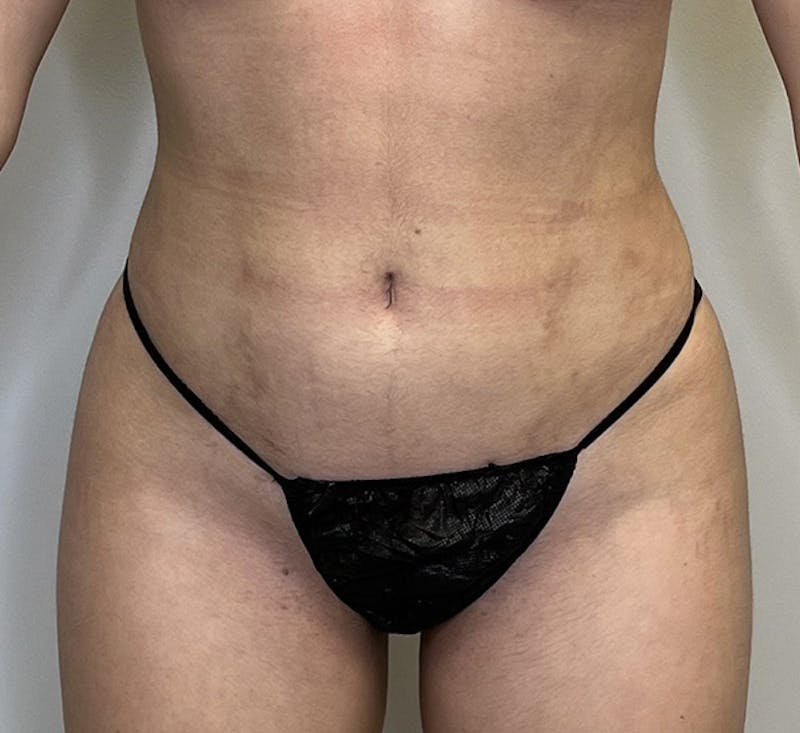 High-definition Liposuction Before & After Gallery - Patient 93894416 - Image 2