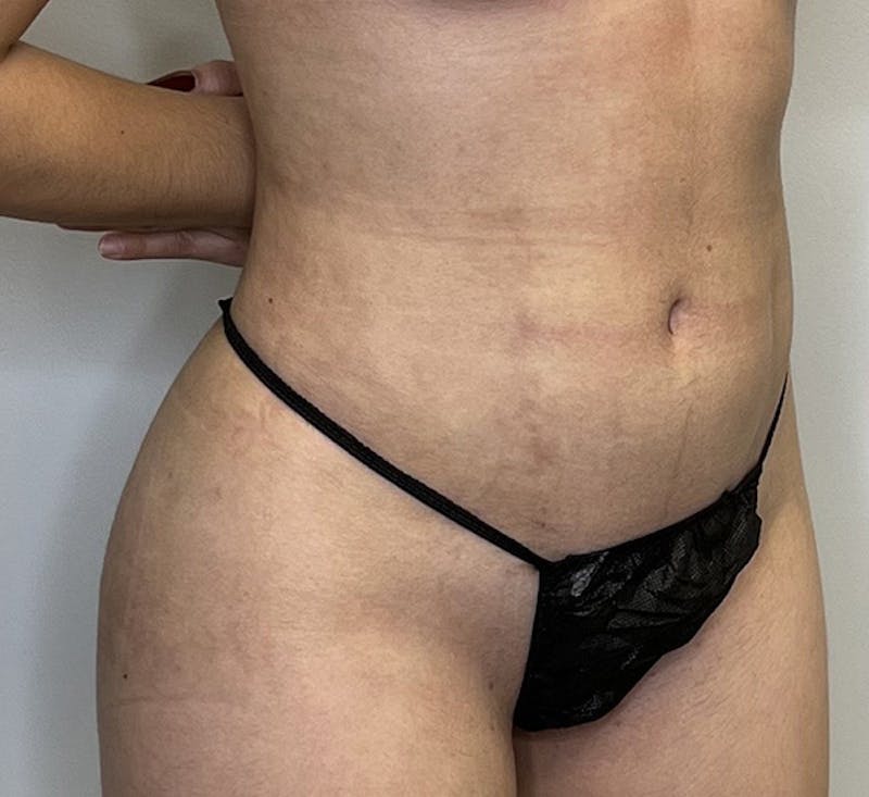 High-definition Liposuction Before & After Gallery - Patient 93894416 - Image 4