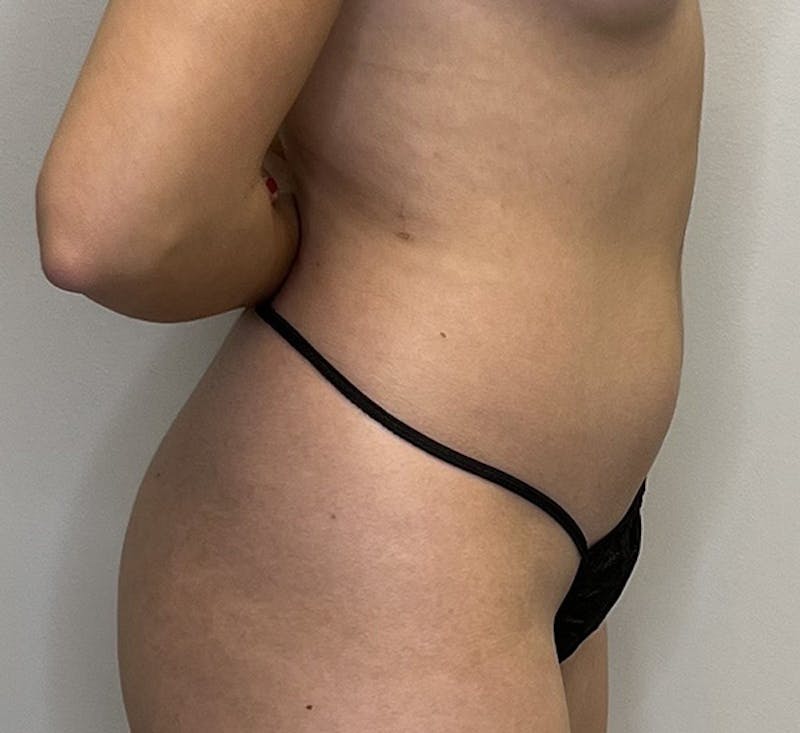 High-definition Liposuction Before & After Gallery - Patient 93894416 - Image 5