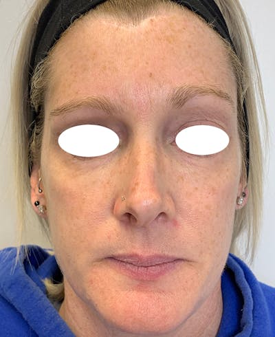 Halo Laser Before & After Gallery - Patient 93894439 - Image 1