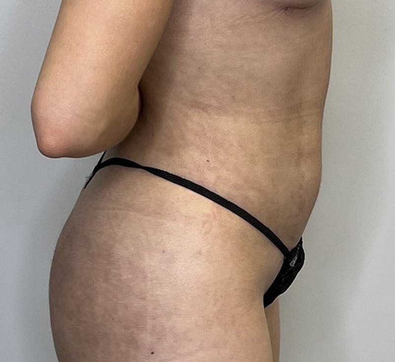 High-definition Liposuction Before & After Gallery - Patient 93894416 - Image 6