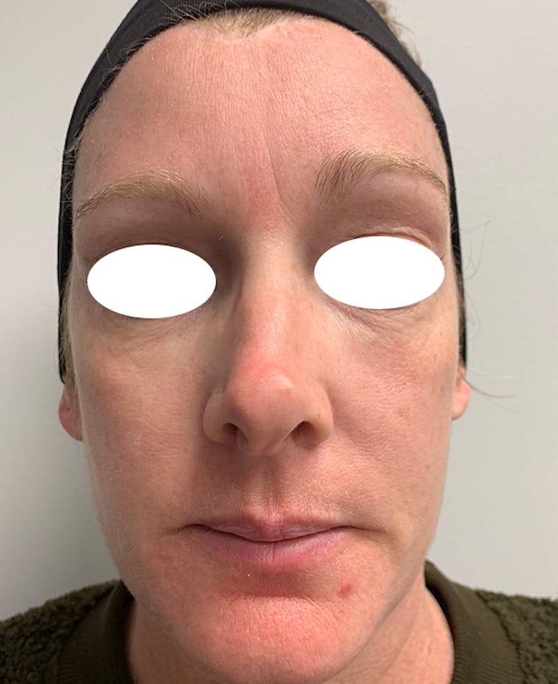 Halo Laser Before & After Gallery - Patient 93894439 - Image 2