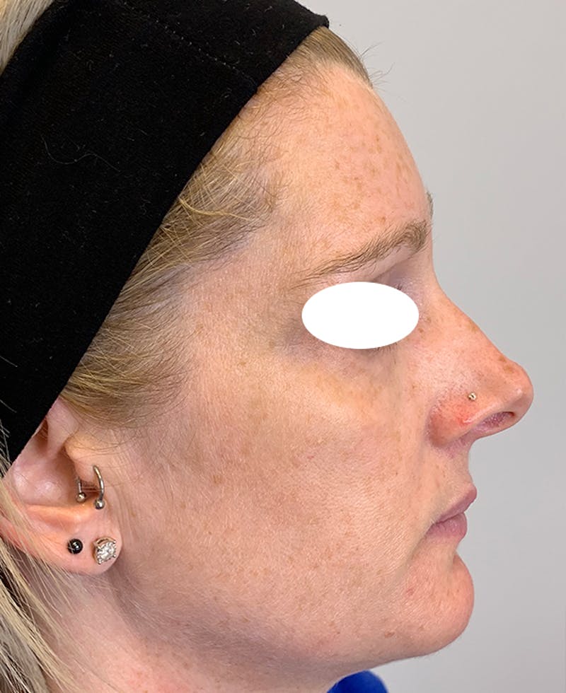 Halo Laser Before & After Gallery - Patient 93894439 - Image 3