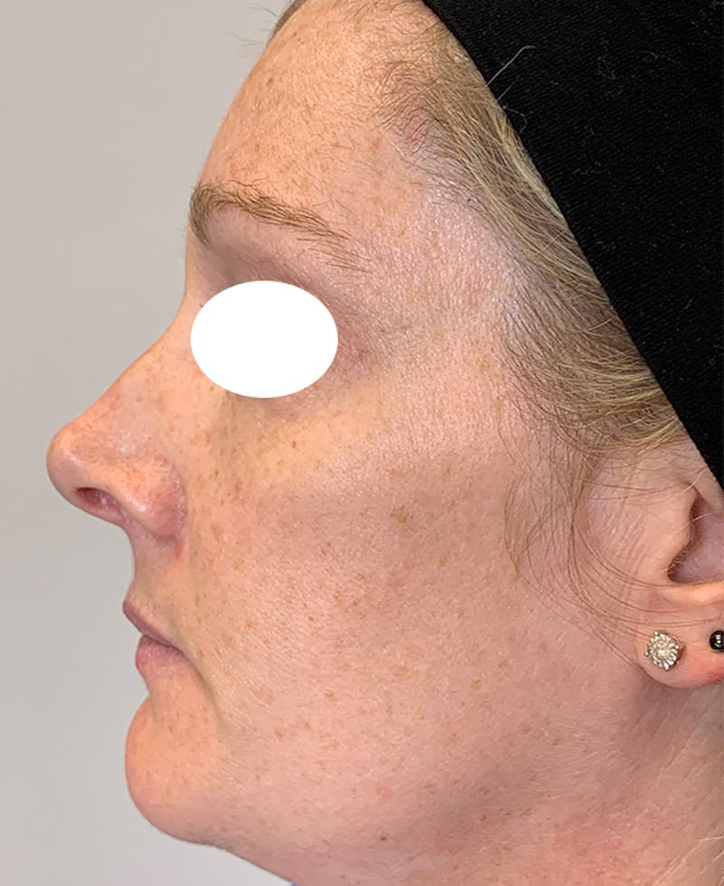 Halo Laser Before & After Gallery - Patient 93894439 - Image 5