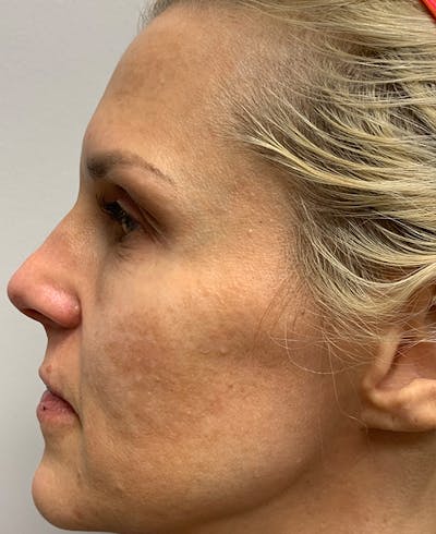 Halo Laser Before & After Gallery - Patient 93894458 - Image 1