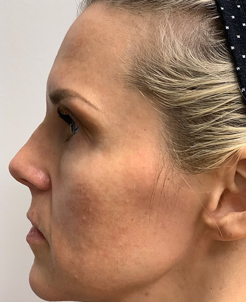Halo Laser Before & After Gallery - Patient 93894458 - Image 2