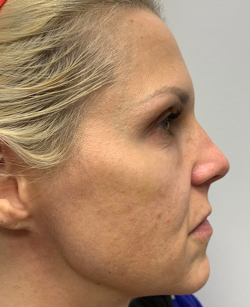 Halo Laser Before & After Gallery - Patient 93894458 - Image 3