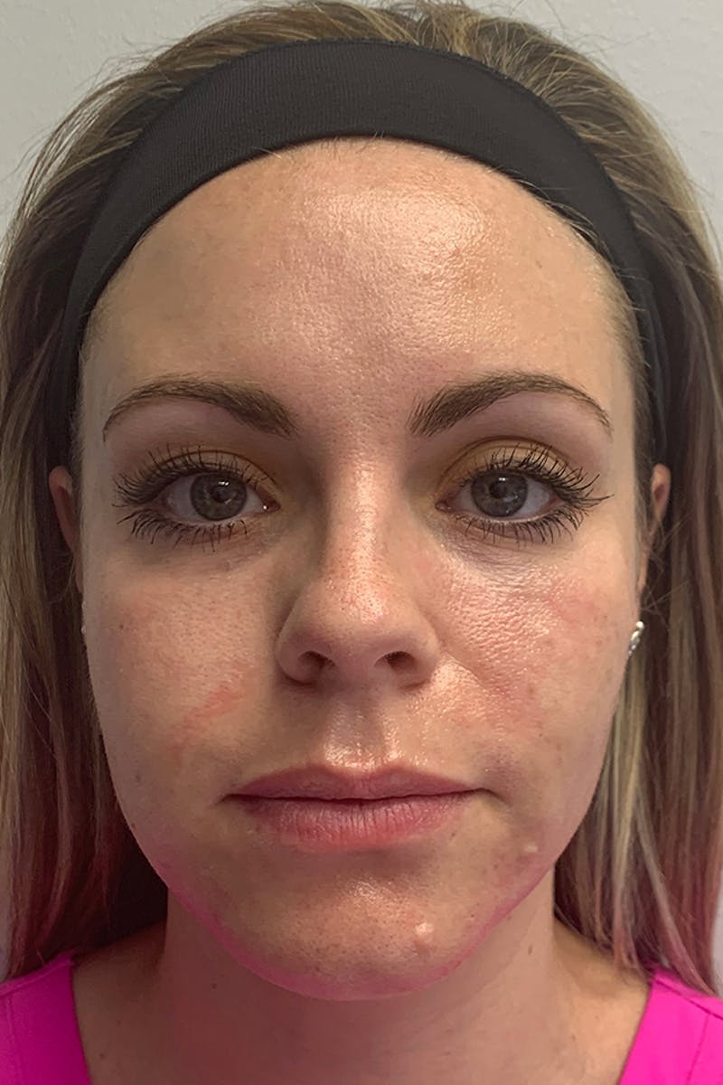 Contour TRL Before & After Gallery - Patient 93894479 - Image 1