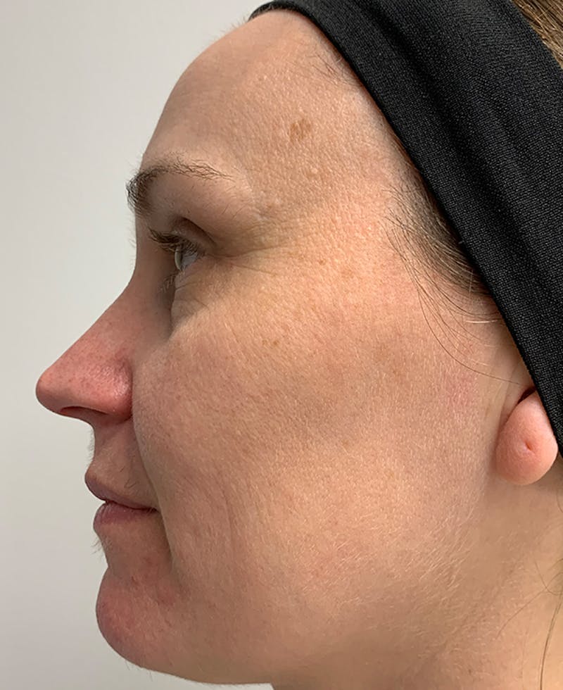 Halo Laser Before & After Gallery - Patient 93894513 - Image 5
