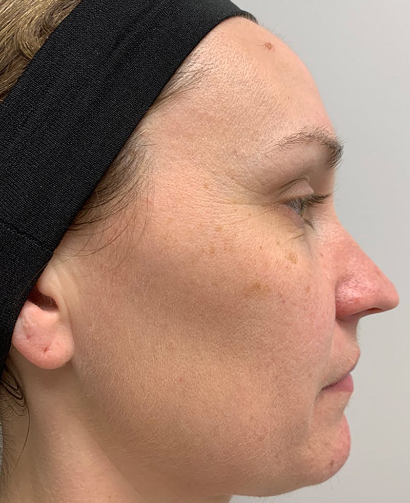 Halo Laser Before & After Gallery - Patient 93894513 - Image 7