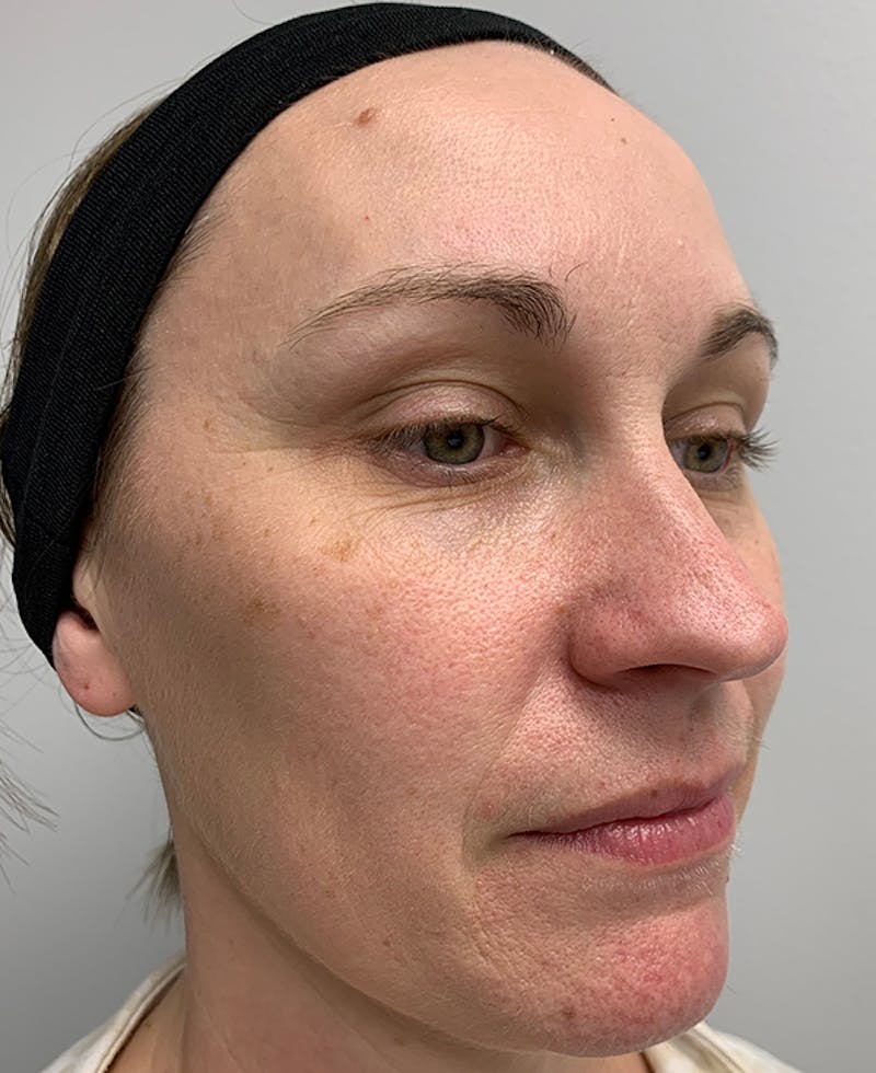 Halo Laser Before & After Gallery - Patient 93894513 - Image 9