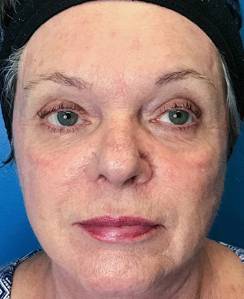 Halo Laser Before & After Gallery - Patient 93894518 - Image 2
