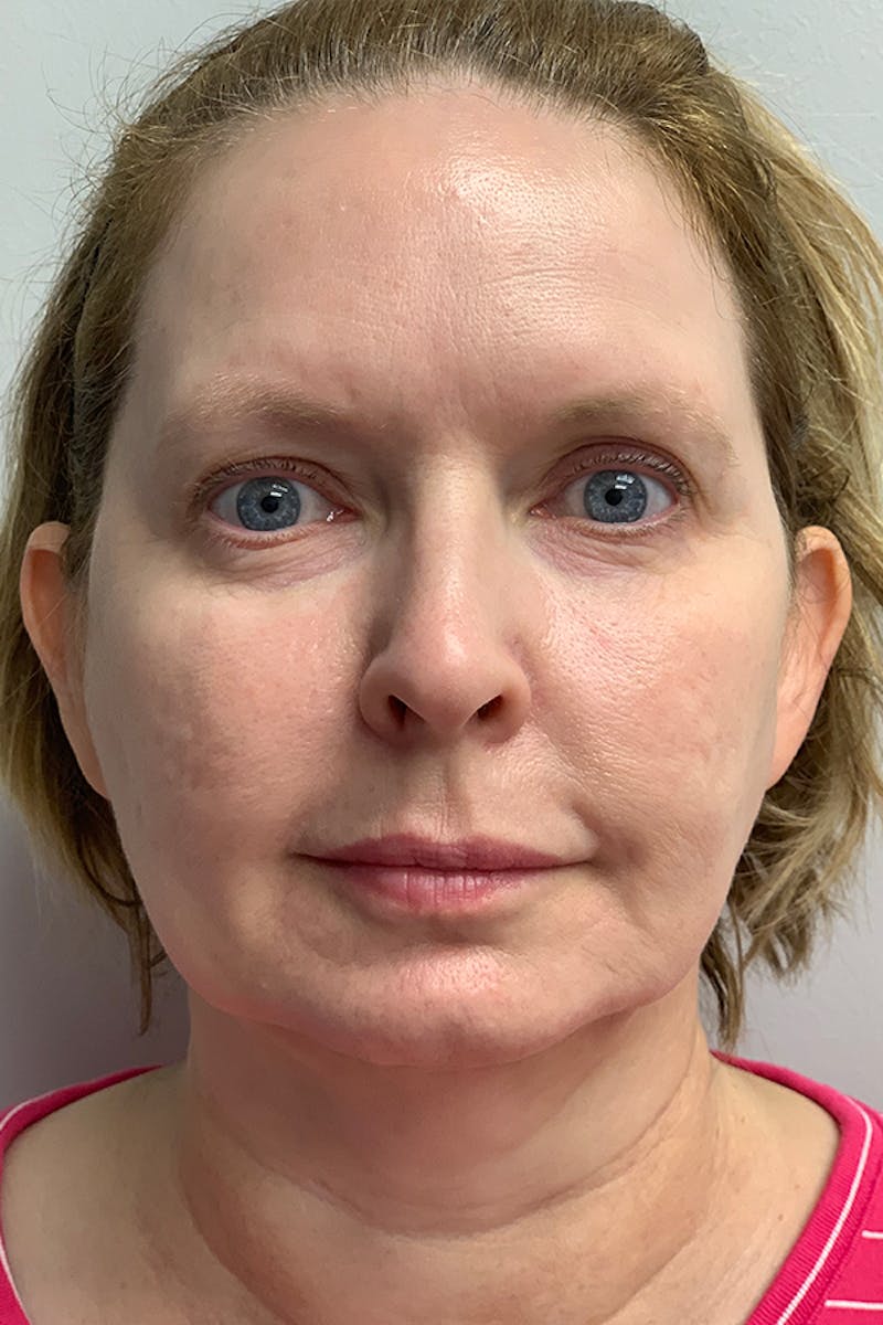 Contour TRL Before & After Gallery - Patient 93894534 - Image 2