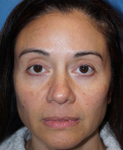 Halo Laser Before & After Gallery - Patient 93894531 - Image 1