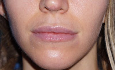 Lip Filler Before & After Gallery - Patient 93894528 - Image 2
