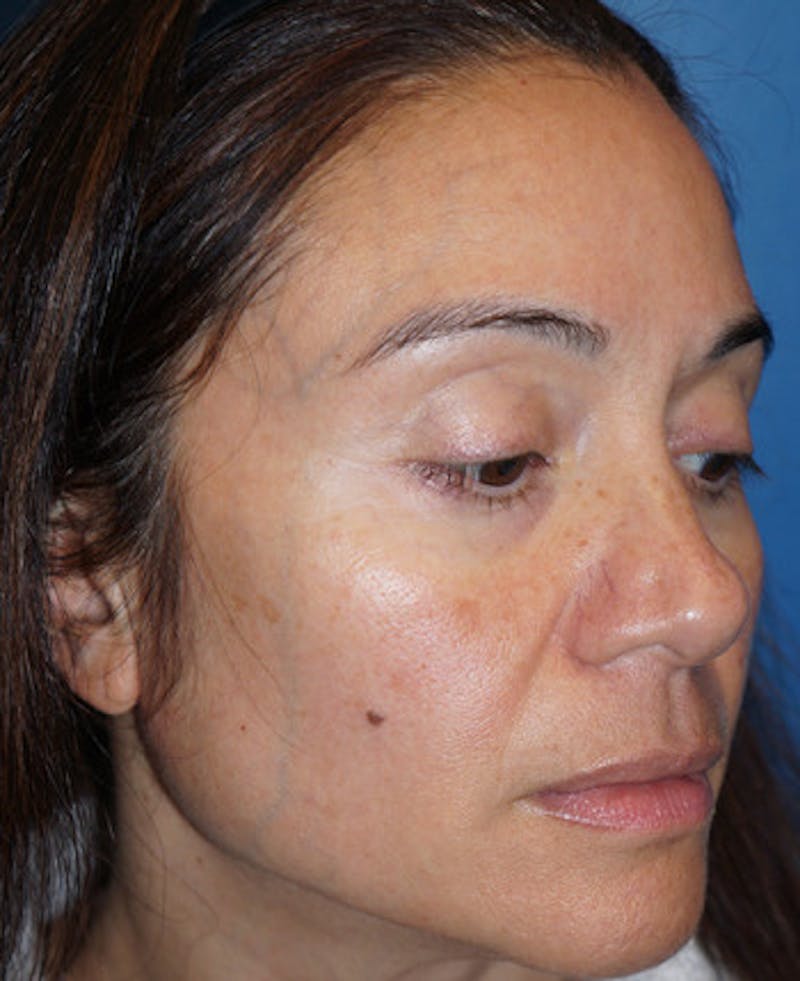 Halo Laser Before & After Gallery - Patient 93894531 - Image 3