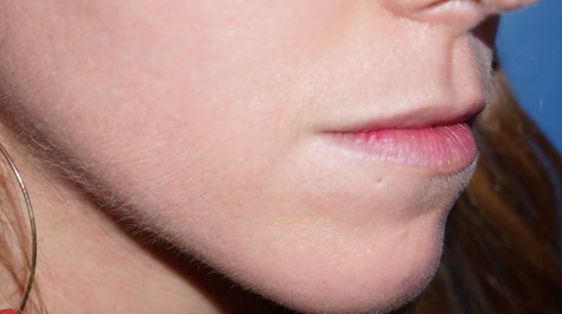 Lip Filler Before & After Gallery - Patient 93894528 - Image 3