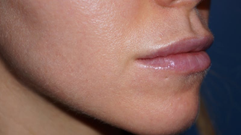 Lip Filler Before & After Gallery - Patient 93894528 - Image 4