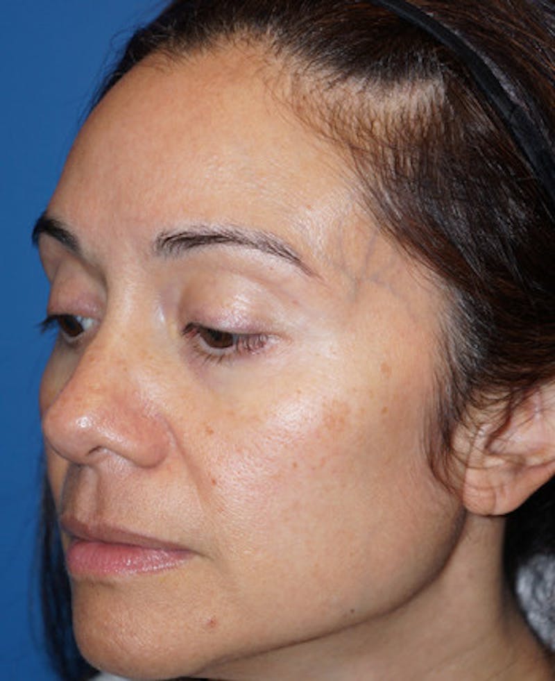 Halo Laser Before & After Gallery - Patient 93894531 - Image 5