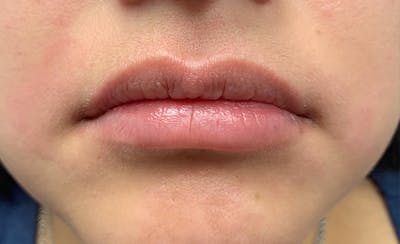Lip Filler Before & After Gallery - Patient 93894536 - Image 1