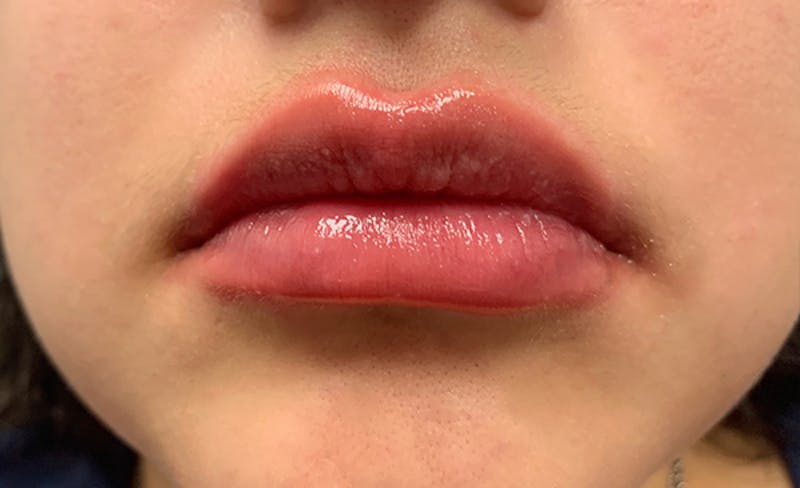 Lip Filler Before & After Gallery - Patient 93894536 - Image 2