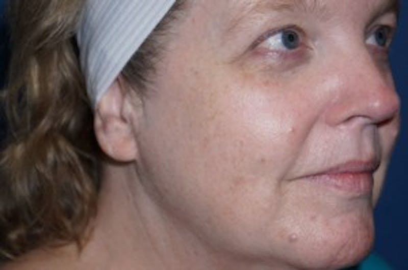 Halo Laser Before & After Gallery - Patient 93894541 - Image 3