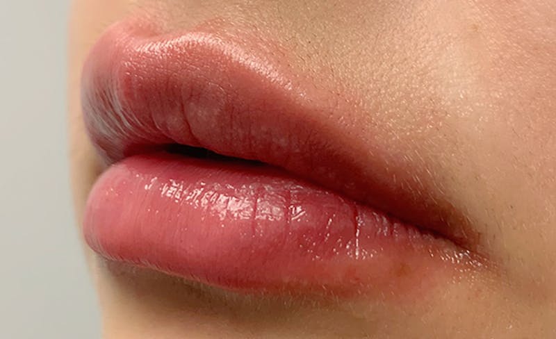 Lip Filler Before & After Gallery - Patient 93894536 - Image 4