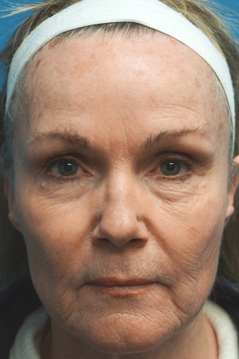 Contour TRL Before & After Gallery - Patient 93894543 - Image 1